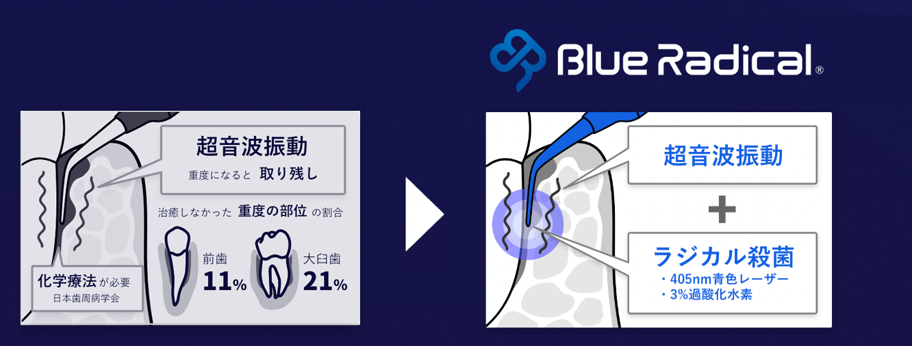 超音波振動のみ